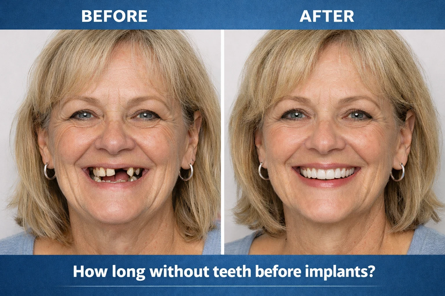 how long without teeth before implants image 1
