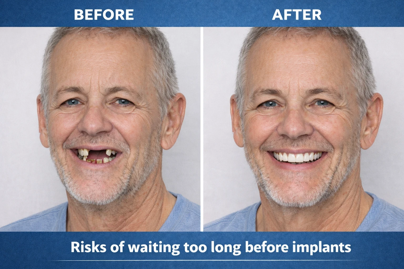Risks of waiting too long before implants image