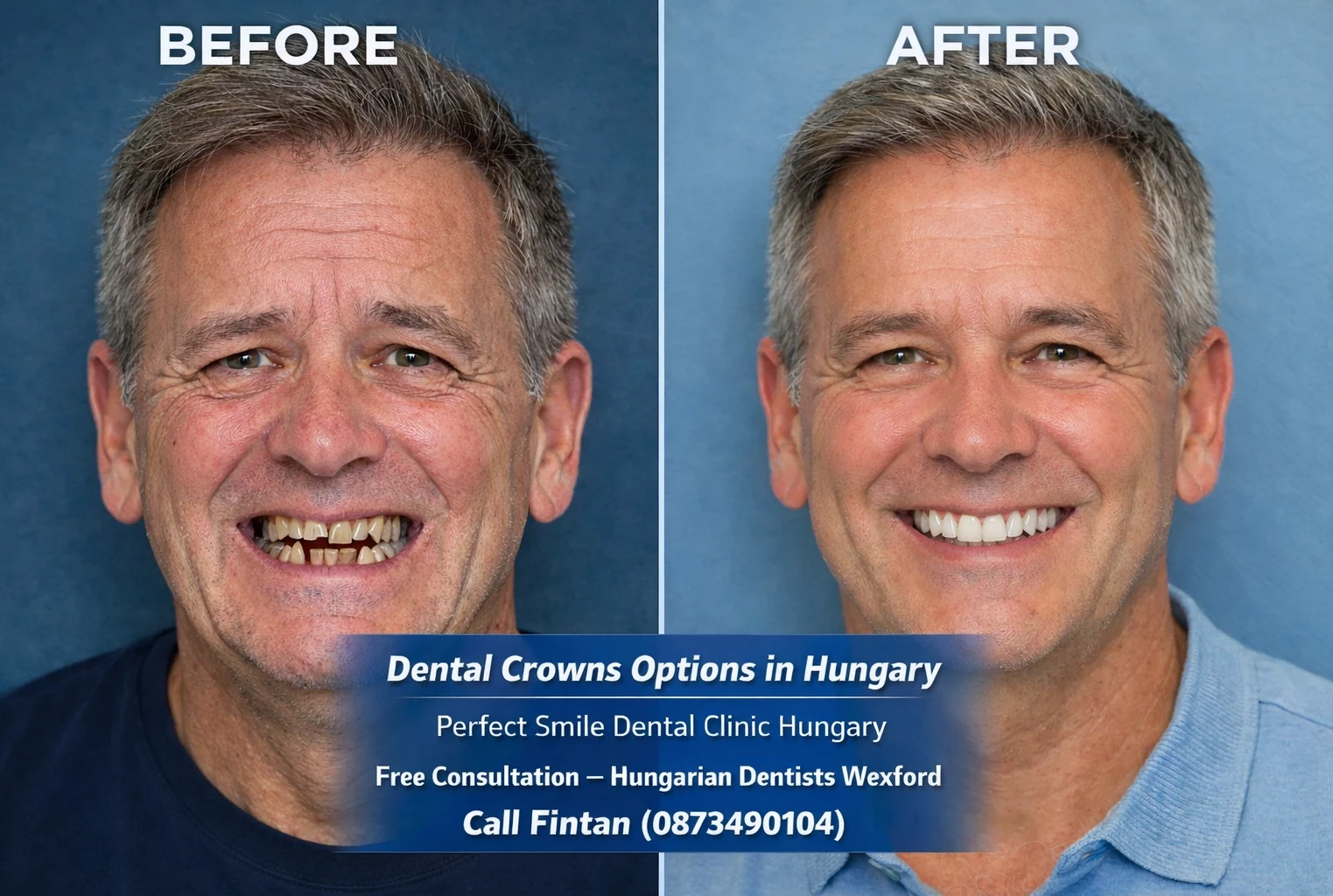 Dental crowns options in Hungary image