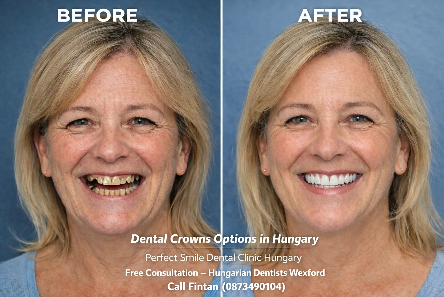 Before and after dental crowns in Hungary image