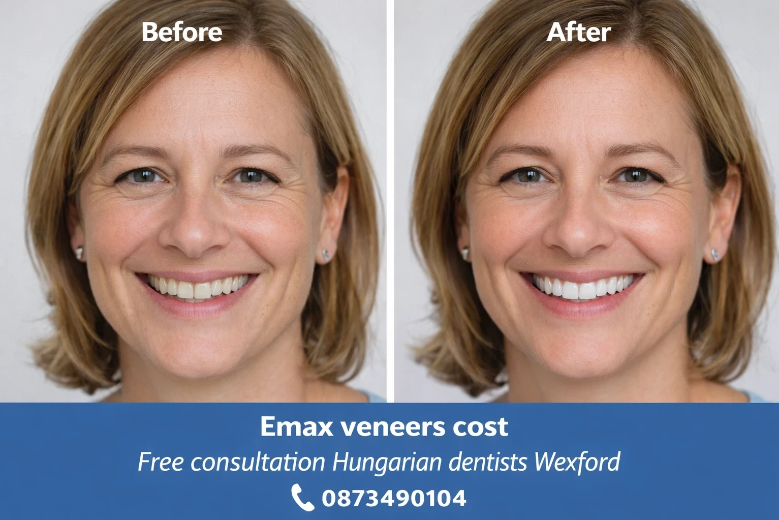 Emax veneers cost image