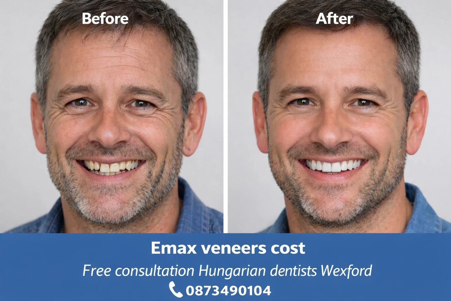 Emax veneers cost in Perfect Smile dental clinic Hungary image 