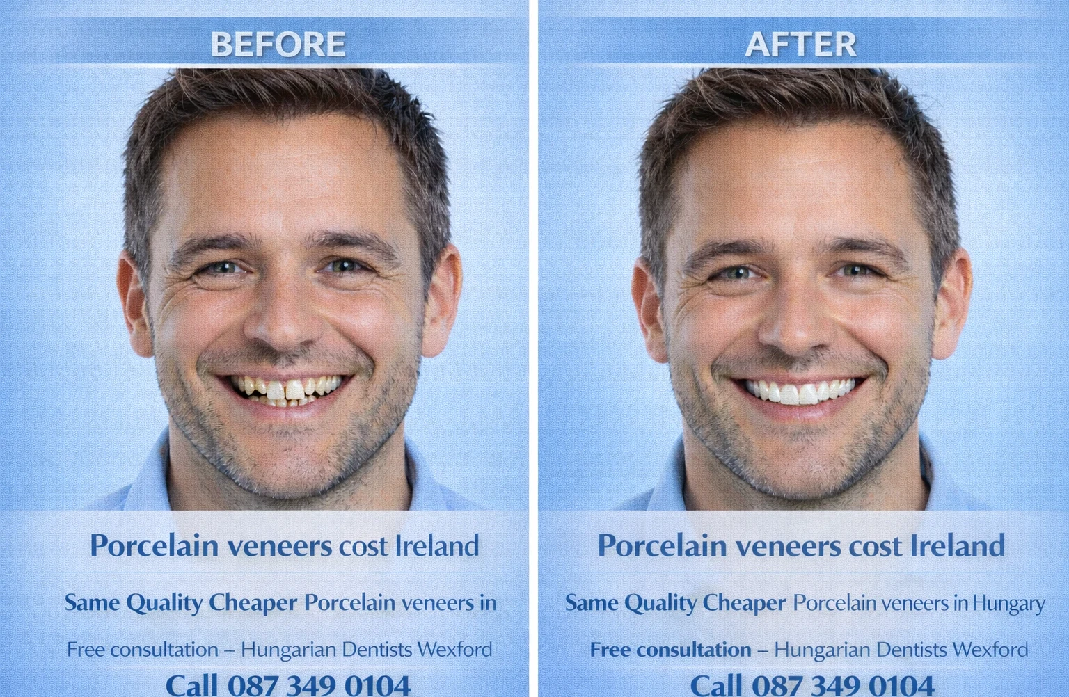 Porcelain veneers cost Ireland image 