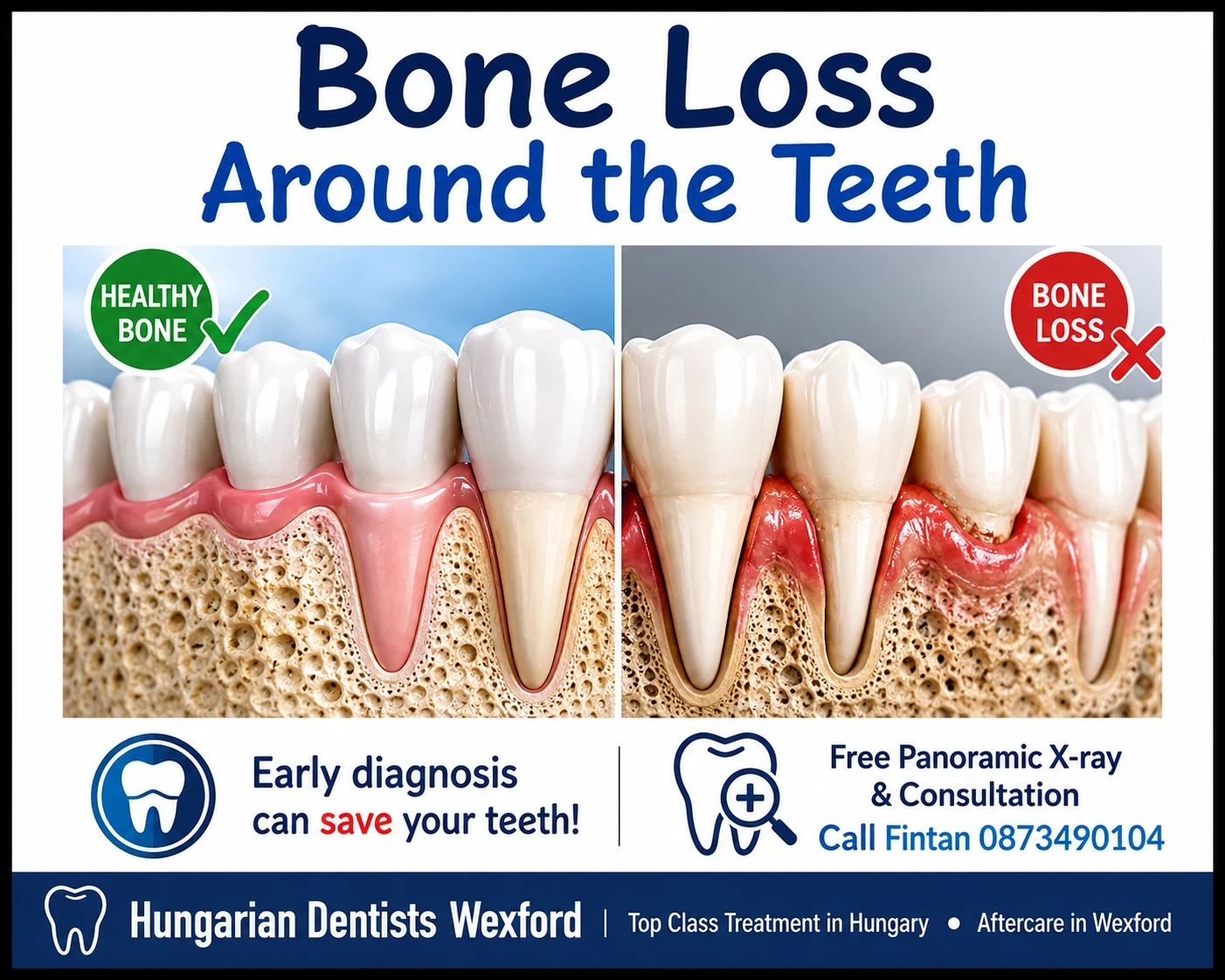 Bone loss around the teeth image