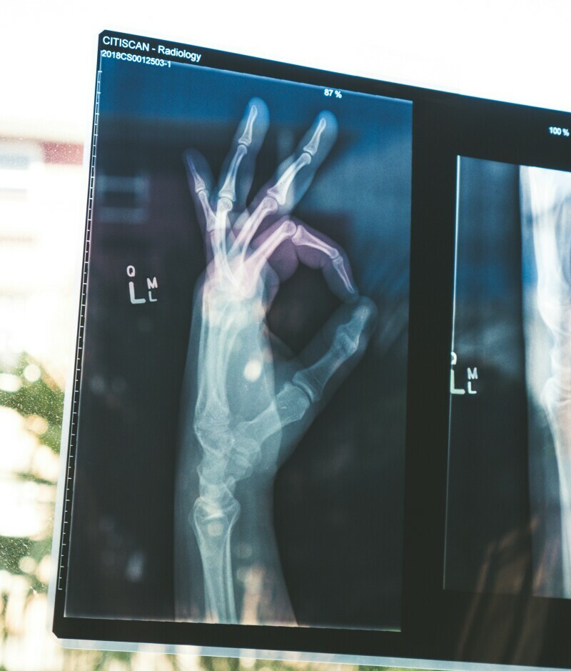x-ray of a person's hand