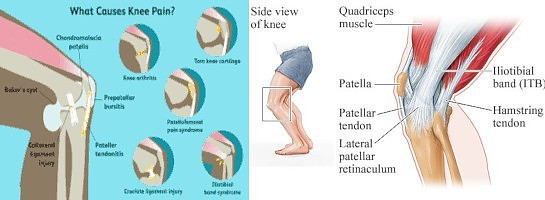 Types Of Knee Pain Explained