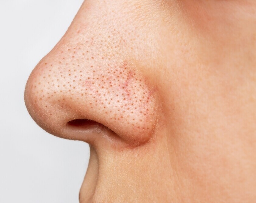 nose closeup showing large pores with blackheads