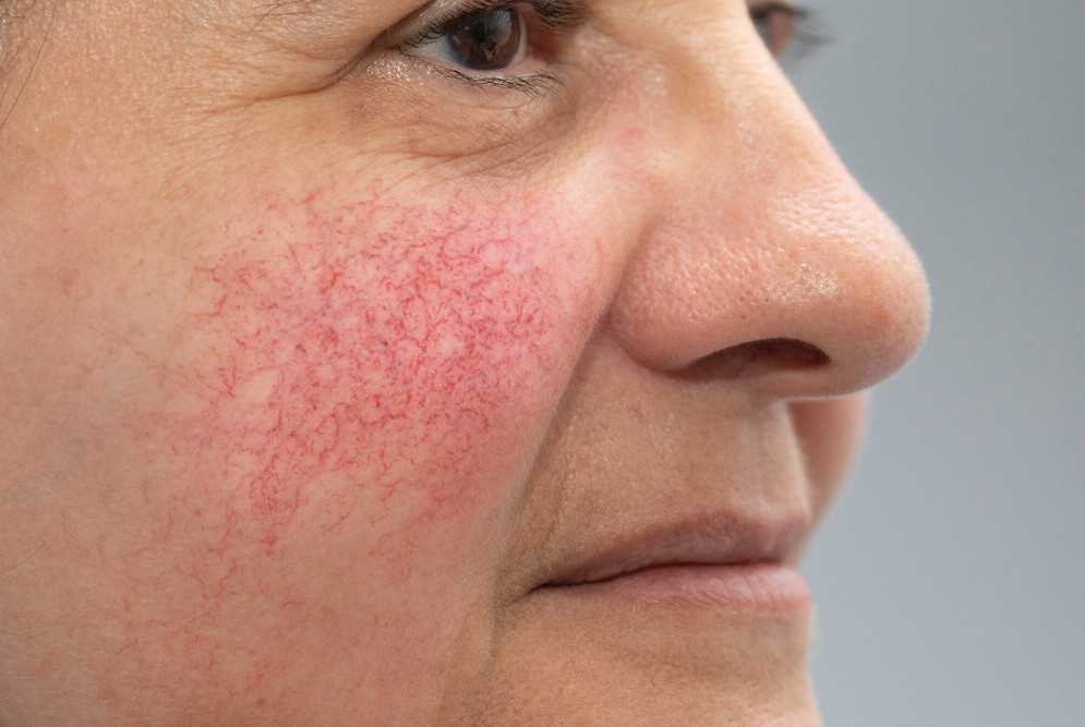 closeup of middle aged lady with rosacea