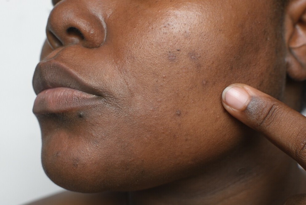 brown skinned lady pointing to dark spots on face