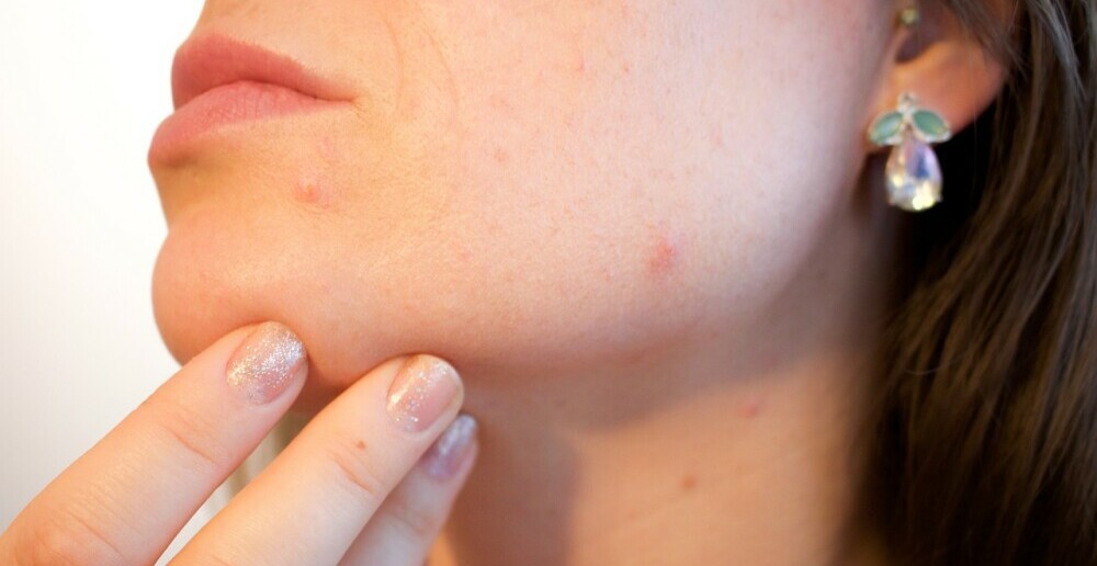 Image of a woman face with skin conditions