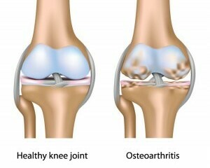 Osteoarthritis