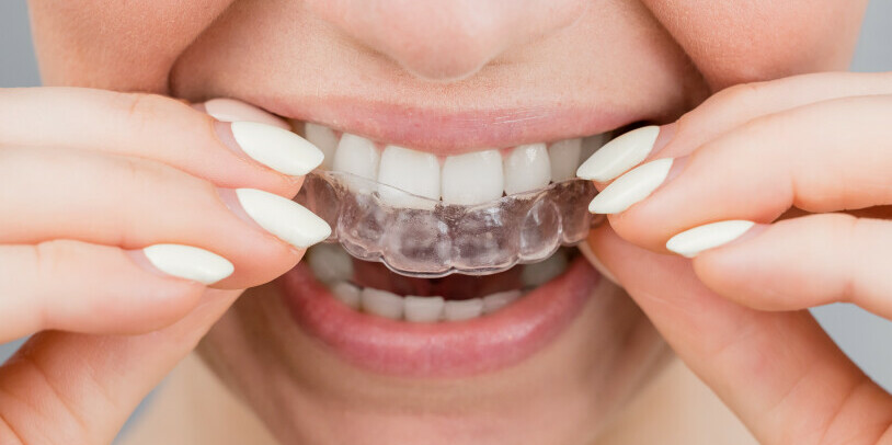 Mouth Guards For Teeth Grinding