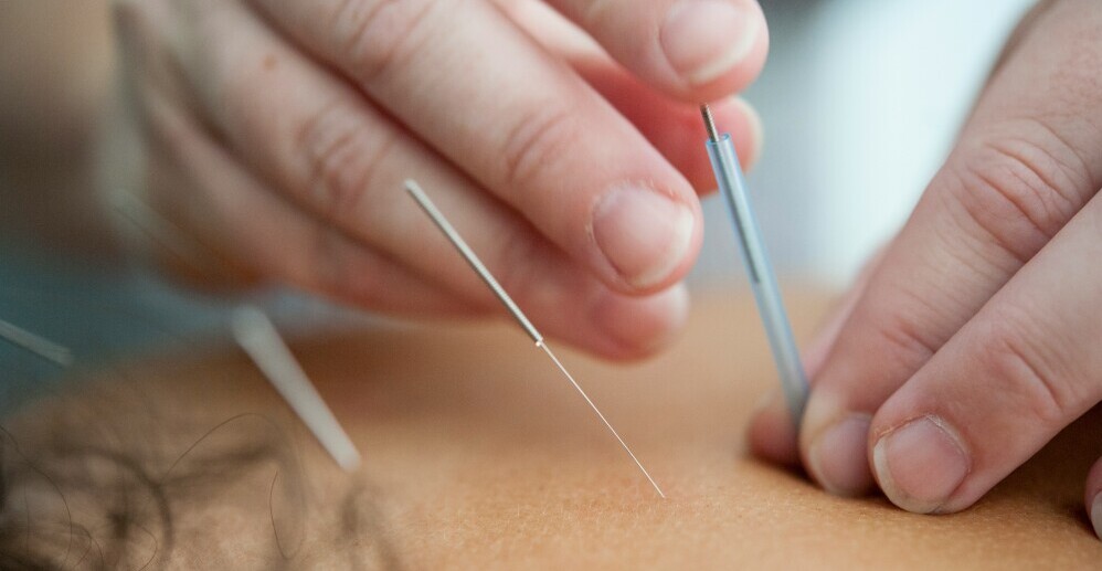 Acupuncture