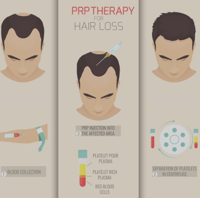 PRP Treatment for Hair Loss