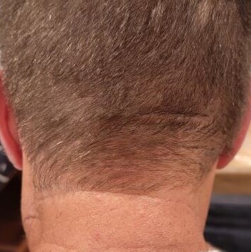 lump in neck