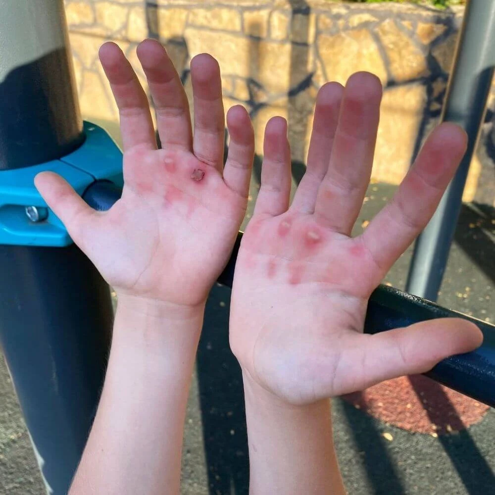 how-to-treat-calluses-on-your-hands-after-workouts