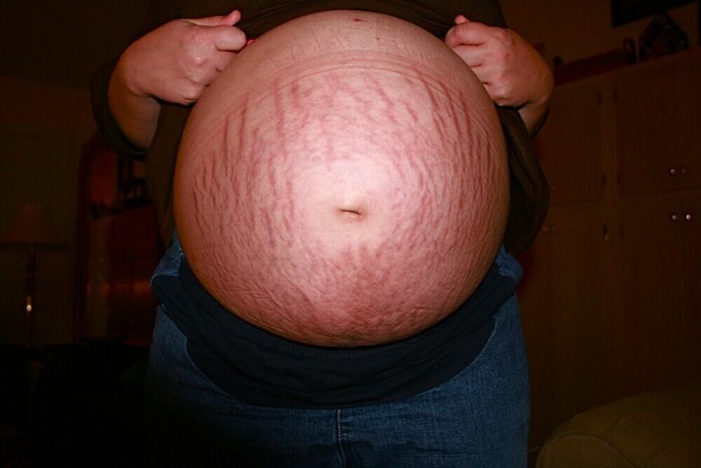 pregnant woman showing her stretch marks