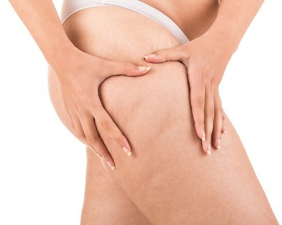 cellulite example