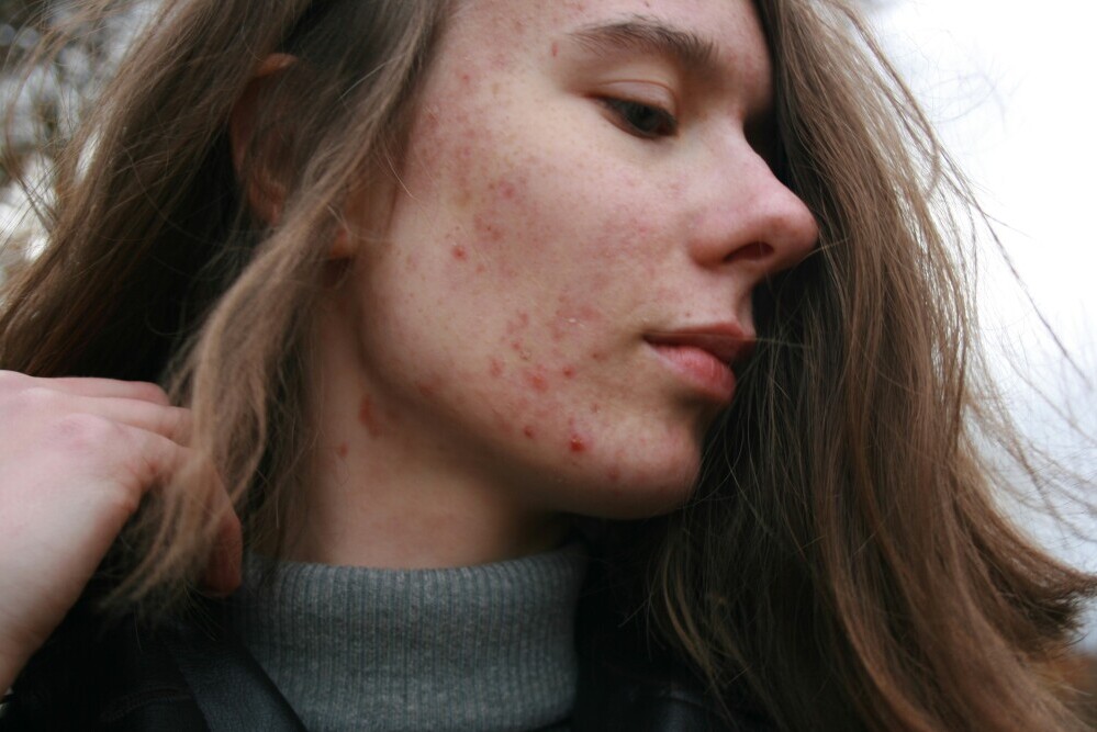 Signs and Symptoms of Pollution-Affected Skin